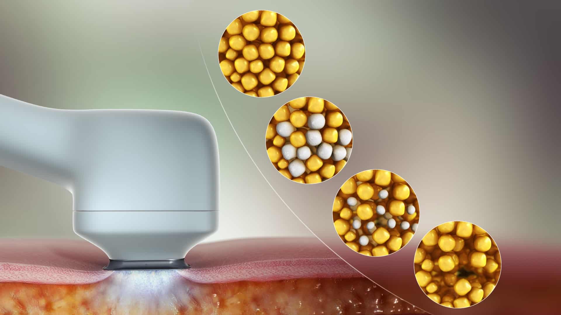 Cryolipolysis - feature image