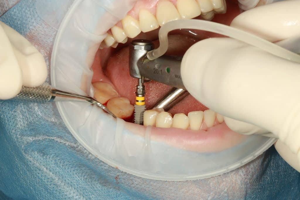 dental implants - featured image